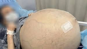 Qadının yumurtalığından 30 kiloqramlıq    şiş çıxardılar