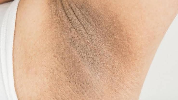 Qolaltı qaralmalar -  Necə xilas ola bilərik? - Həkimdən açıqlama