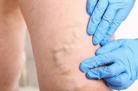  Ayaqlarda tromblar - Necə bilinir?