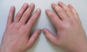 Əlləriniz tez-tez şişir  - Nəyi yoxladaq?