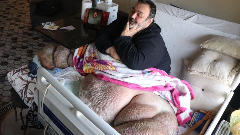 48 yaşlı kişi 300 kiloqrama çatdı:  5 ildir çölə çıxmır-FOTO