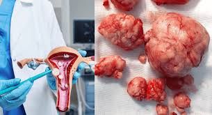 Uşaqlıqda mioma yarandısa  – Nə etməli?