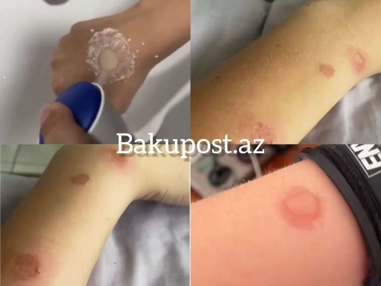 Gənclər özlərini yandırır – Sosial şəbəkələrdə qorxunc trend -  Deodorant Challenge - VİDEO