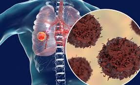 Kişilərdə ağciyər xərçəngi birinci yerdədir, səbəbi...  - Onkoloq  Vüsalə Tağıyeva