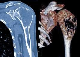 Xərçəngin sümüklərə yayılmasının əlamətləri 