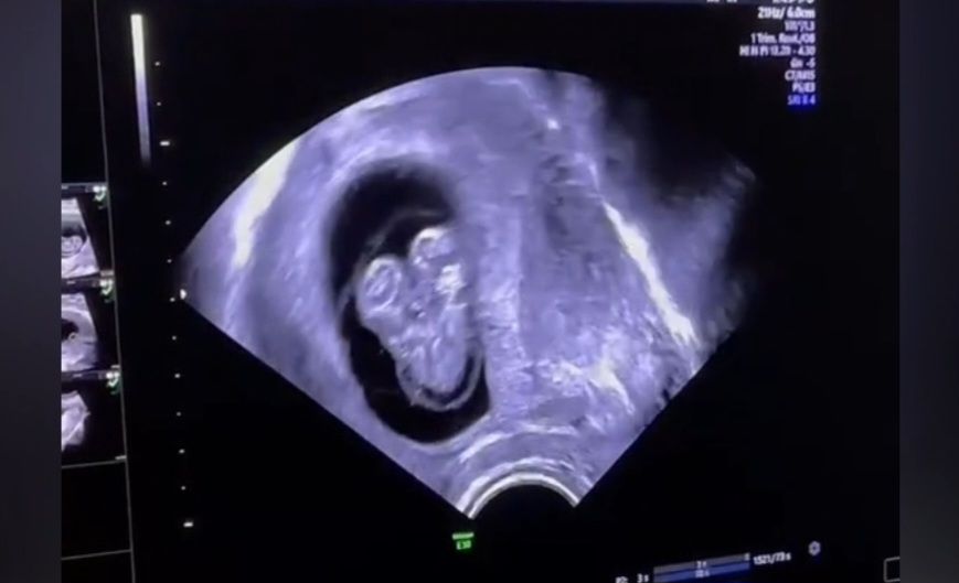 Azərbaycanda hamilədə Siam əkizləri görüldü - Video