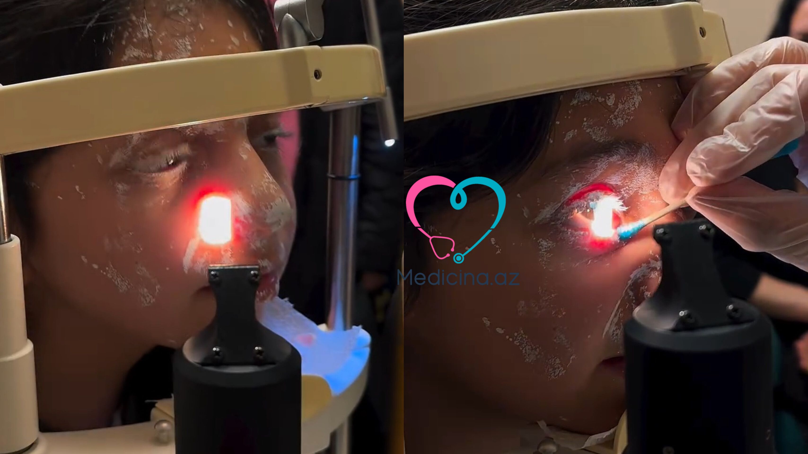 Şagirdin istifadə etdiyi ağardıcı partladı -  Gözü zədələndi - VİDEO