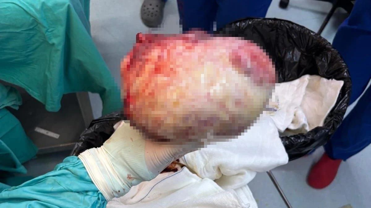 Qadının qarnından 6 kiloqramlıq kista çıxarıldı -  FOto