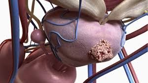 Kişilərdə bu aqressiv xərçəng genetikdir 