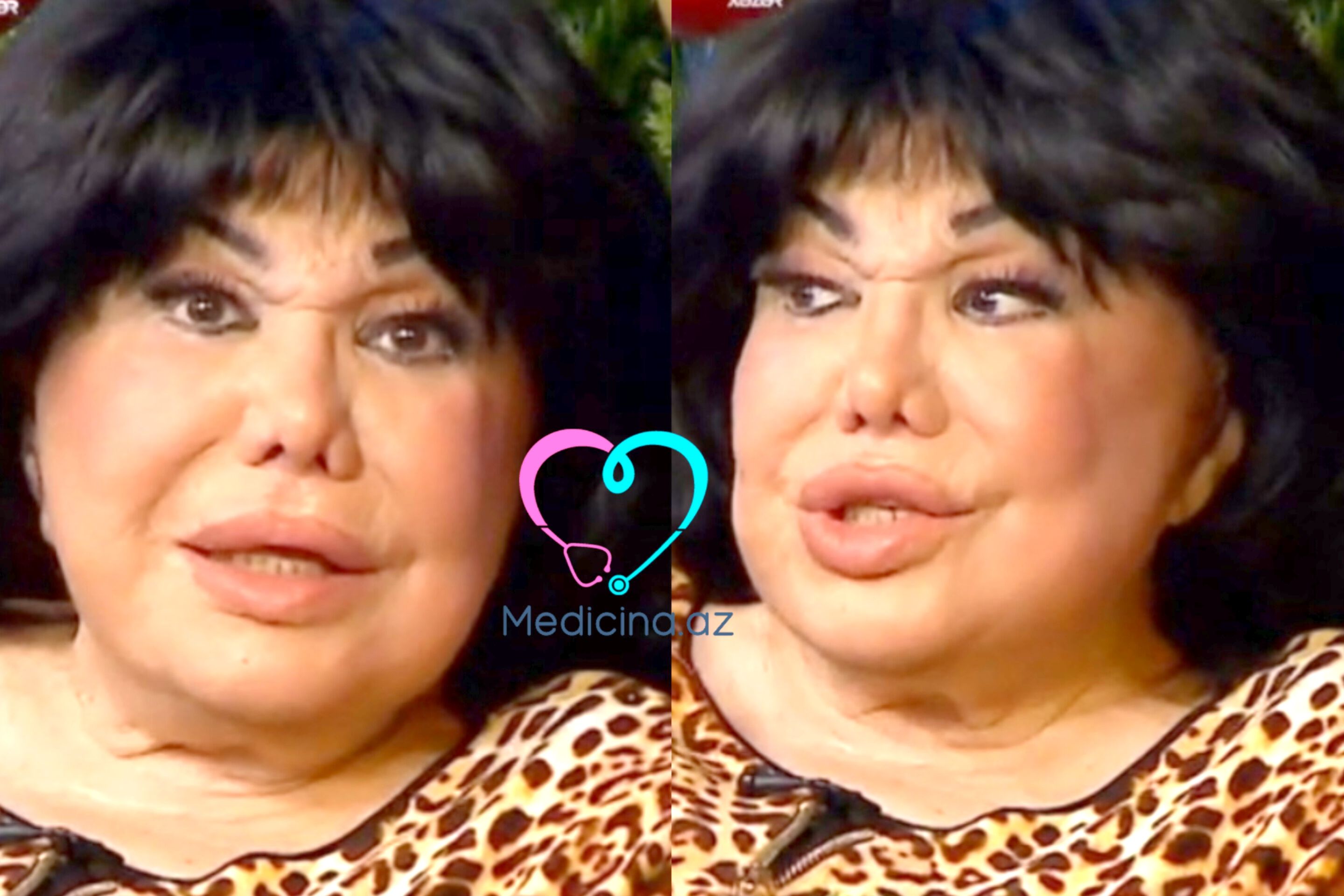 Flora Kərimovanın üzünə nə olub? -  "Yaxşı deyiləm" - VİDEO