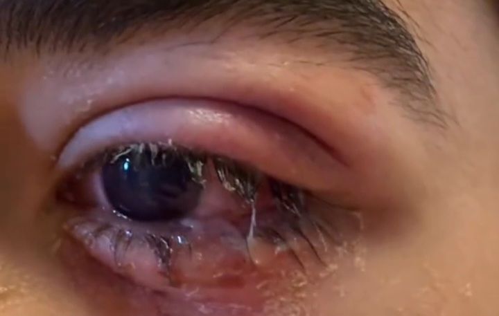 "Partladan" partlatdı - Gözü zədələndi -  VİDEO