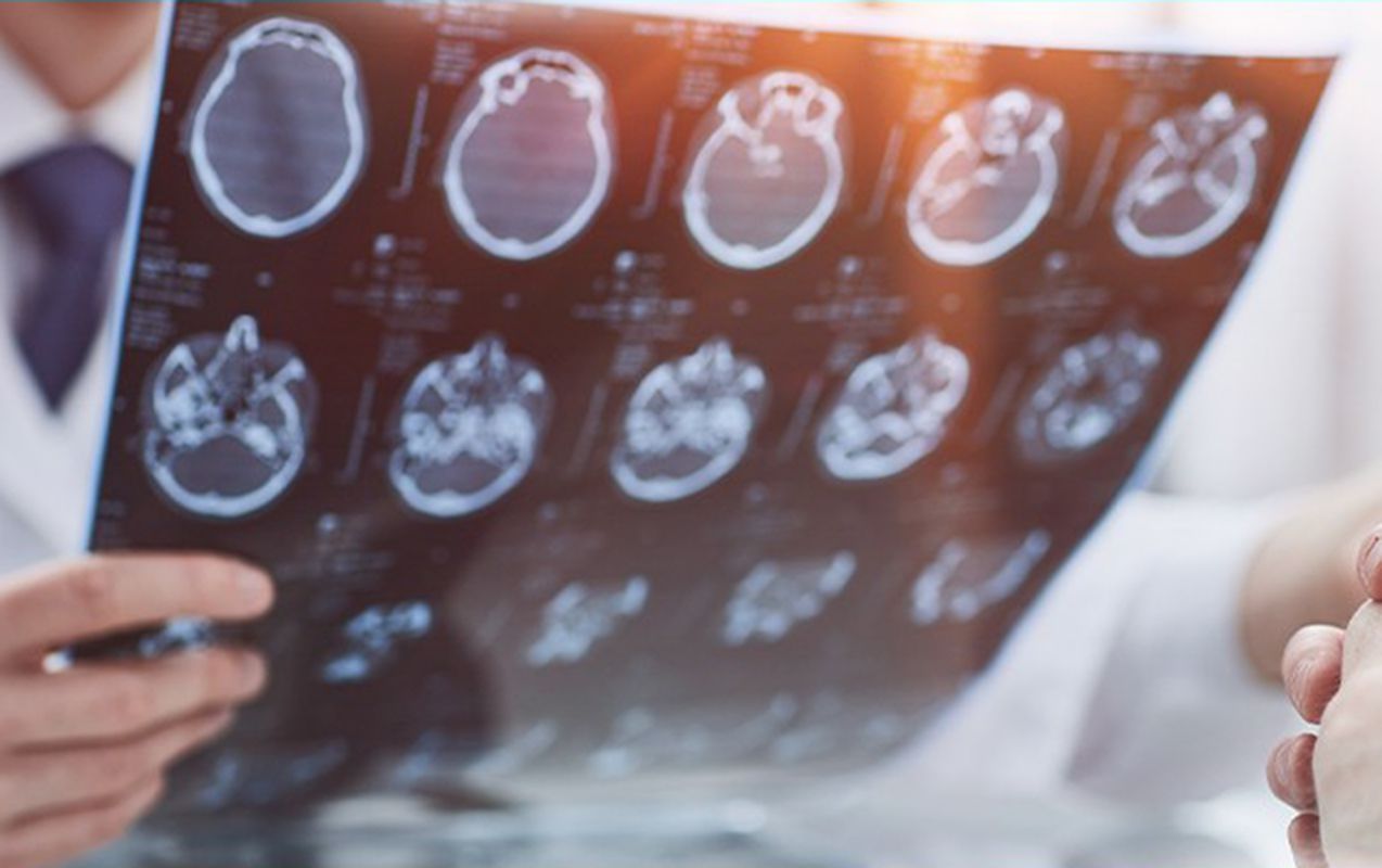 İnsultun müayinə və müalicəsi icbari tibbi sığorta ilə qarşılanır 