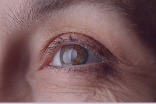 Gözlə beyin arasında əlaqənin pozulduğu xəstəlik 