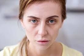 Bir baxışla qanazlığı diaqnozu qoymaq olmaz 