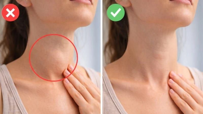 Evdə qalxanabənzər vəzinin müayinəsi:  Güzgü qarşısında dayanın və yoxlayın