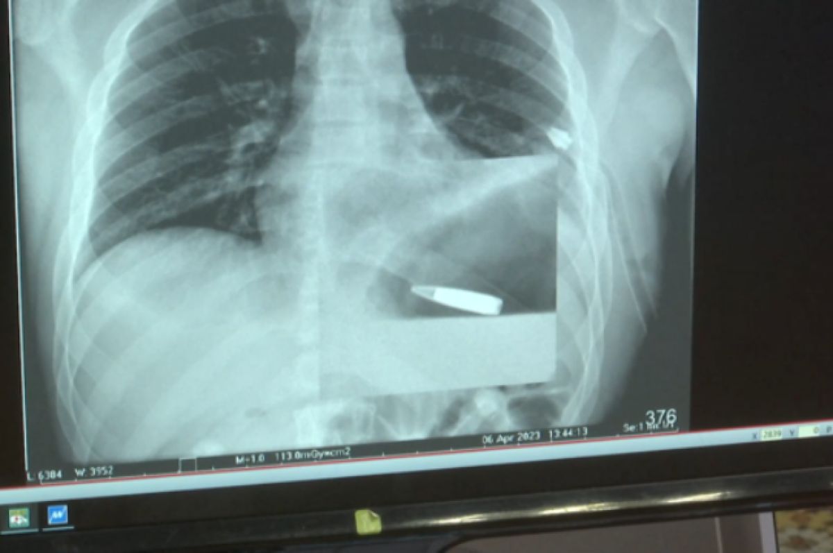 Ürəyinə güllə keçən kişi əməliyyat olundu 