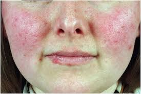 Doktor Hausun sevdiyi xəstəlik  – Qırmızı qurd eşənəyi necə görünür?