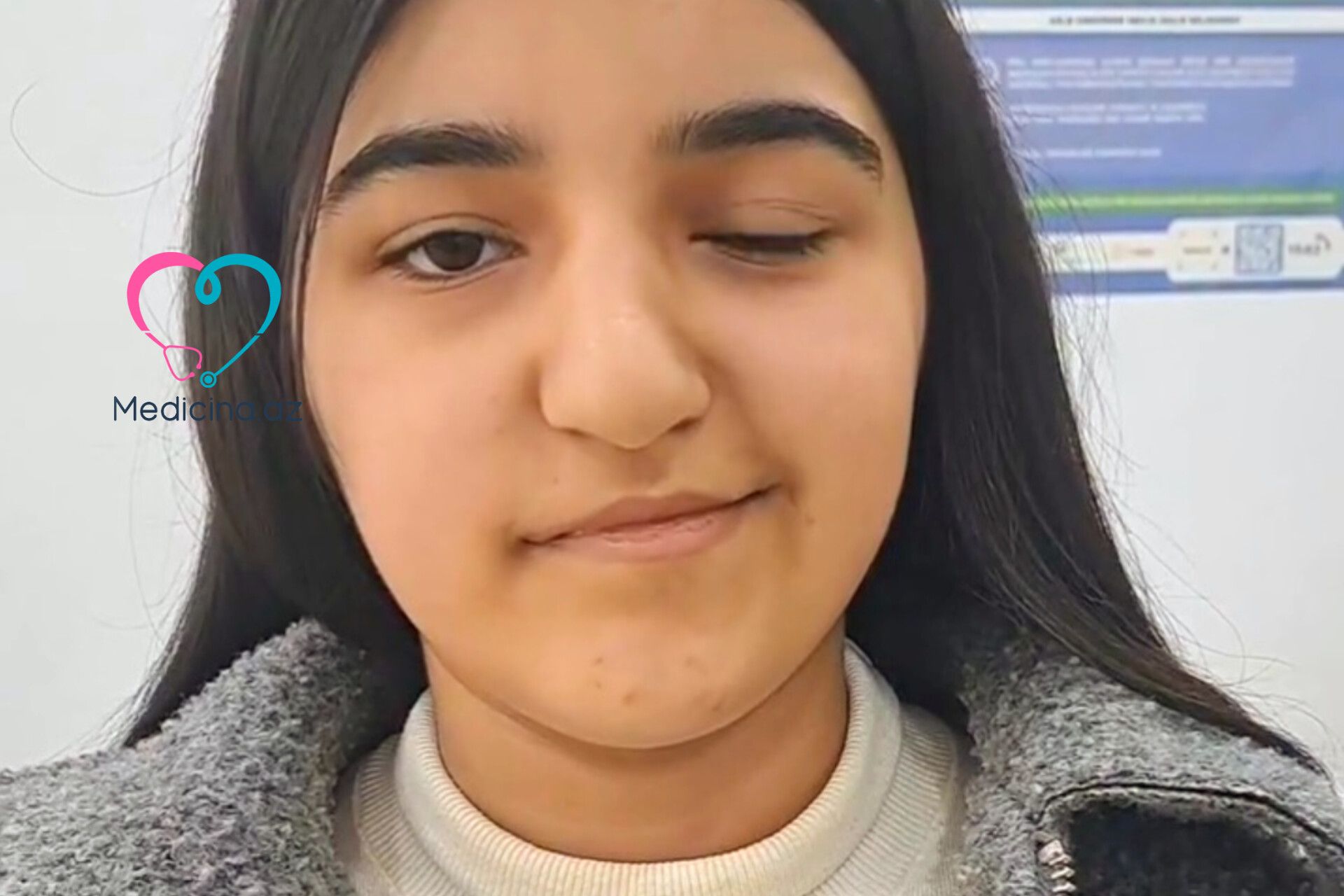 İnfluenza virusu yeniyetmənin üzünü iflic etdi -  VİDEO