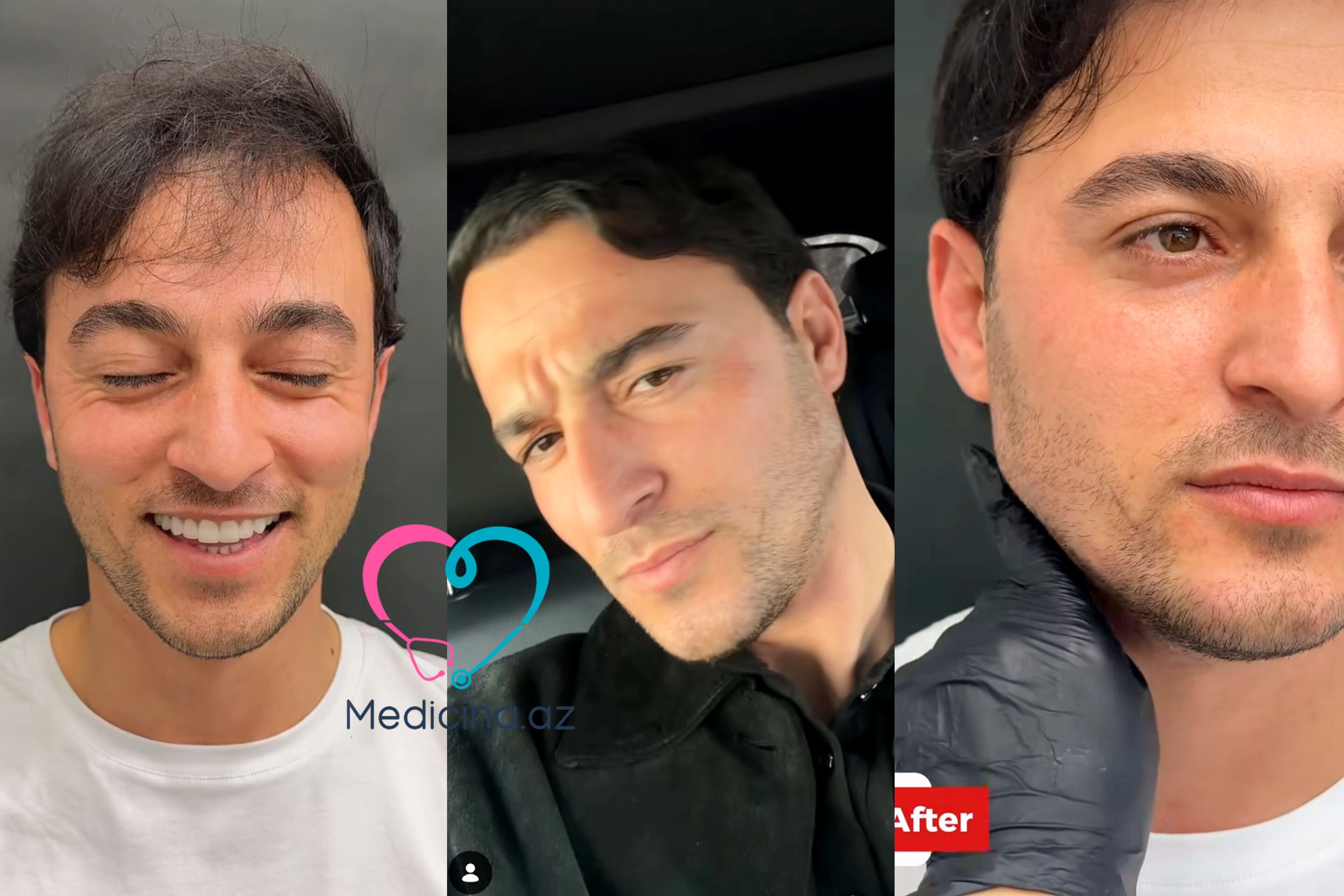 İqo üzünə estetik prosedur etdirdi -  VİDEO