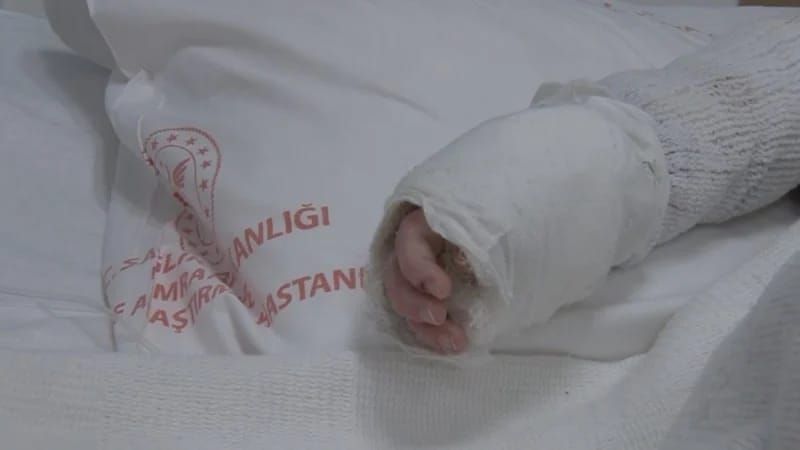 Körpənin üstünə qaynar su töküldü:  Bədəninin 27%-i yandı 