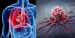 Xərçəngin inkişafına təsir edən     gizli amil