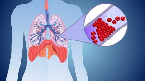 Ağciyər emboliyasını müalicəsi  edən cihaz    - kəşf edildi