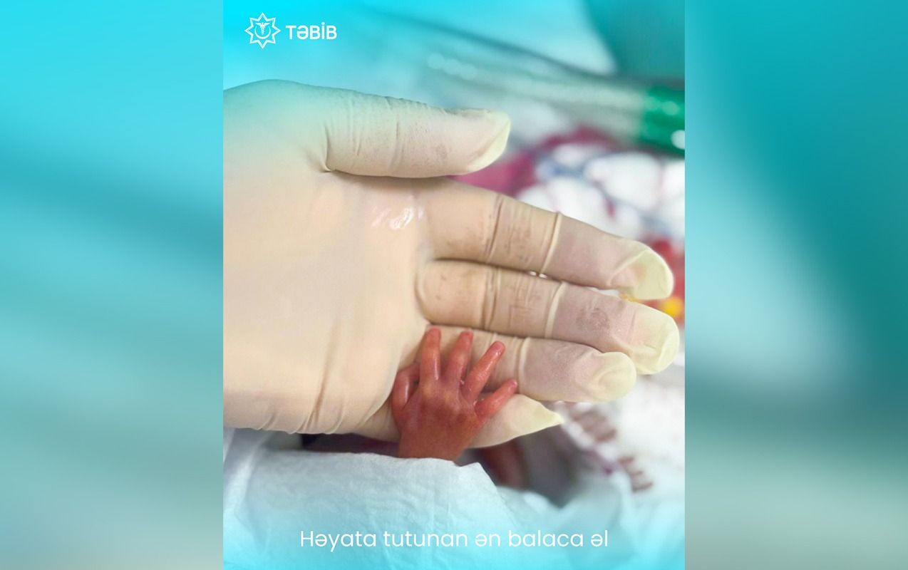 15 ildən sonra 540 qram çəkidə doğulan Nur... -  FOTO