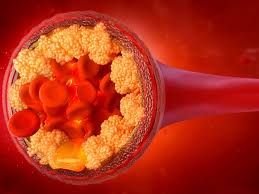 Pis" xolesterolu 60% azaldan dərman kəşf edildi 