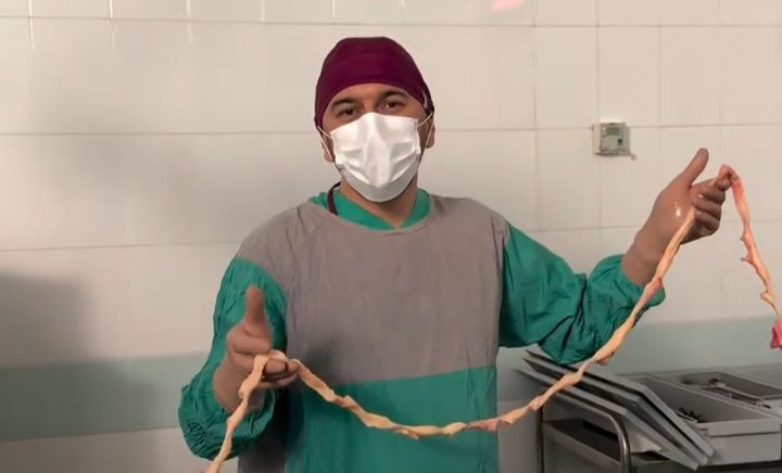 Qadından çıxarılan miomanın ölçüsü hər kəsi təəccübləndirdi -  VİDEO