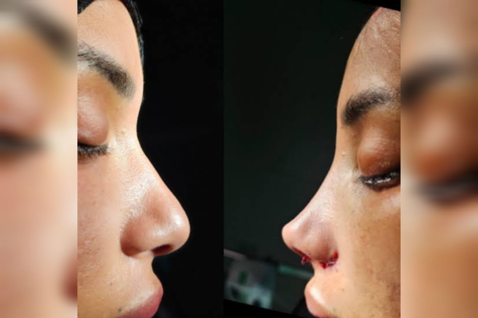 Ən təhlükəli burun trendi -  "Barbie nose"