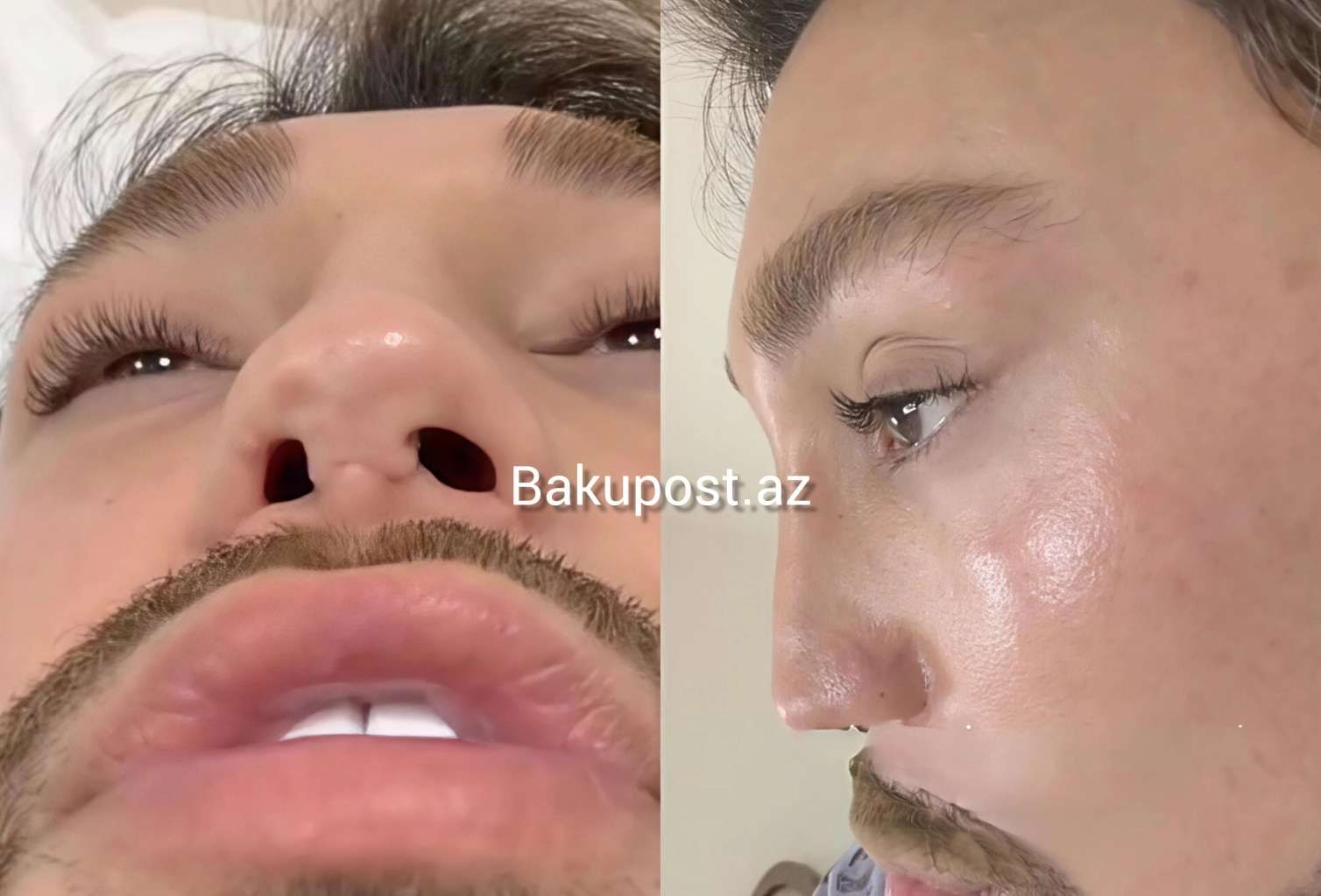 4 dəfə uğursuz əməliyyat etdirən stilist   - Həkimləri ifşa etdi - Adlar