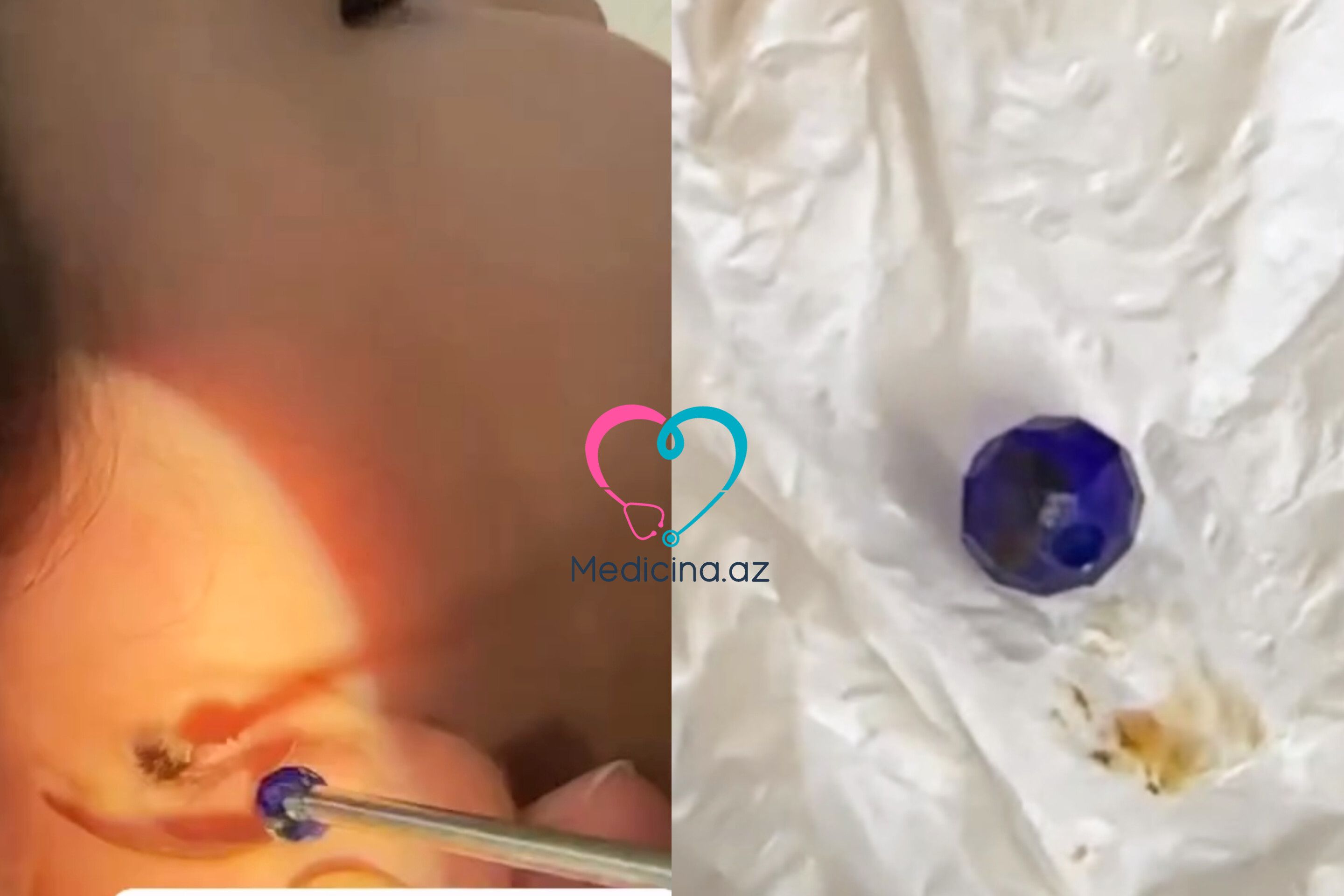 Uşağın qulağından muncuq çıxdı -  Həkimdən xəbərdarlıq-VİDEO