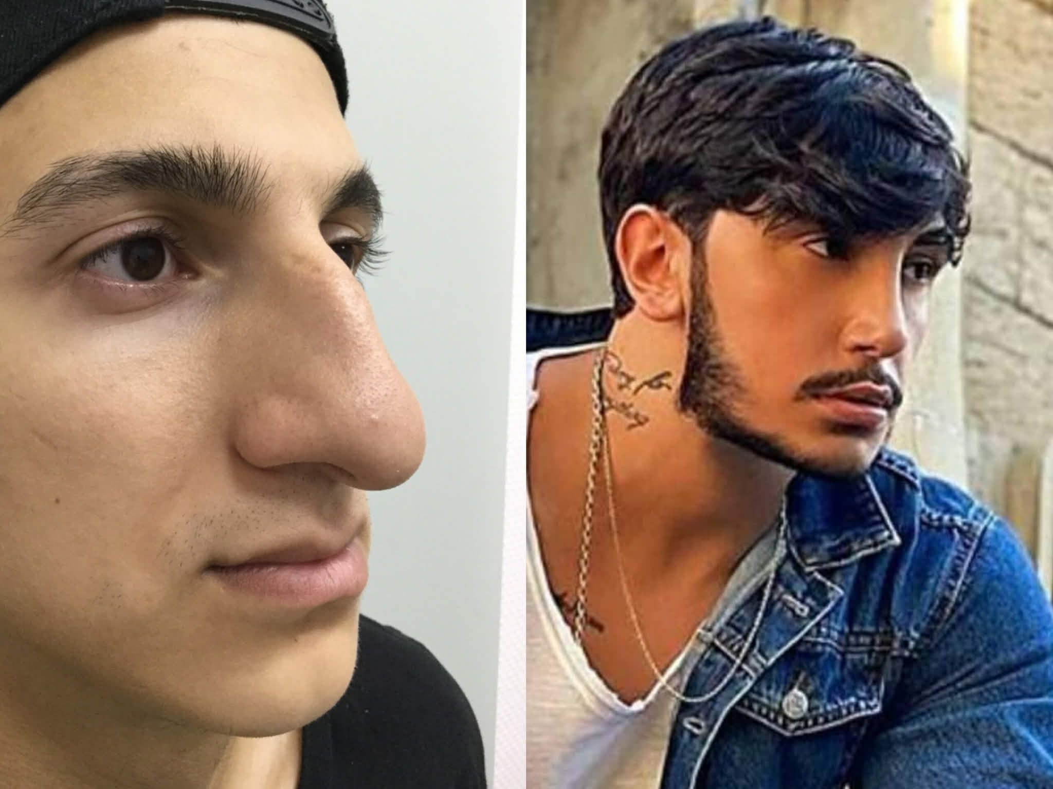 LOR cərrah stilistin yalanını üzə çıxardı  -  Əvvəlki burnu ilə müqayisə edin - FOTOFAKT