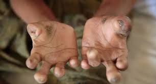 Azərbaycanda aşkarlanan qeyri-adi nadir xəstəliklər 