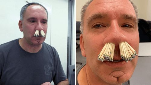  Təcili yardım həkimi burnuna 91 kibrit saldı 