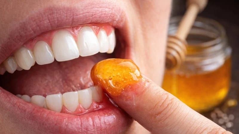 Təbii müalicə -   Diş ətlərinə bal çəkmək sizi diş həkimindən xilas edir