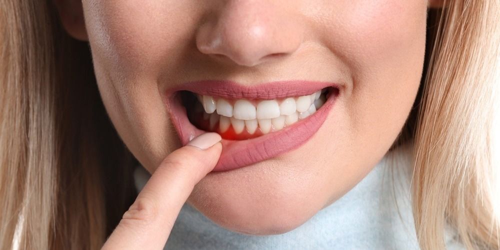 Təbii müalicə -   Diş ətlərinə bal çəkmək sizi diş həkimindən xilas edir