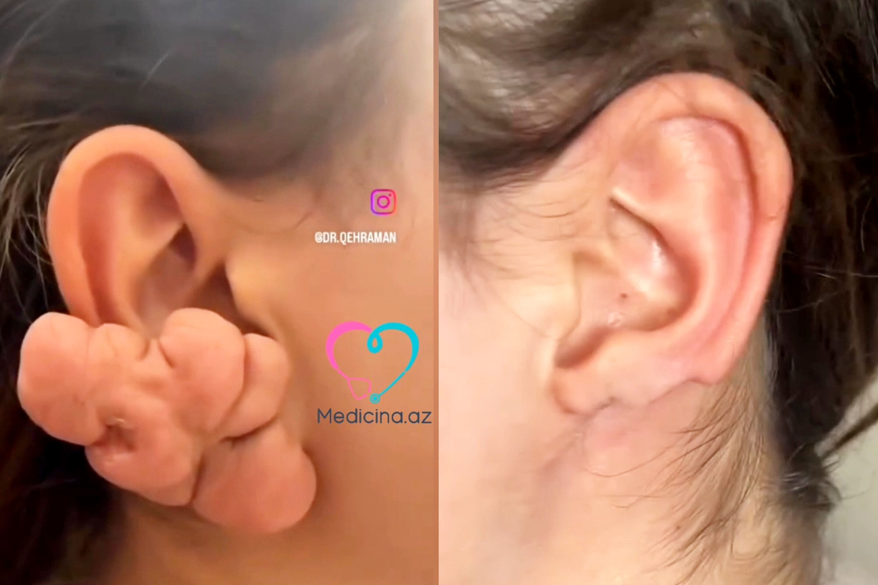 Sırğadan sonra qulağı bu hala düşdü -  VİDEO