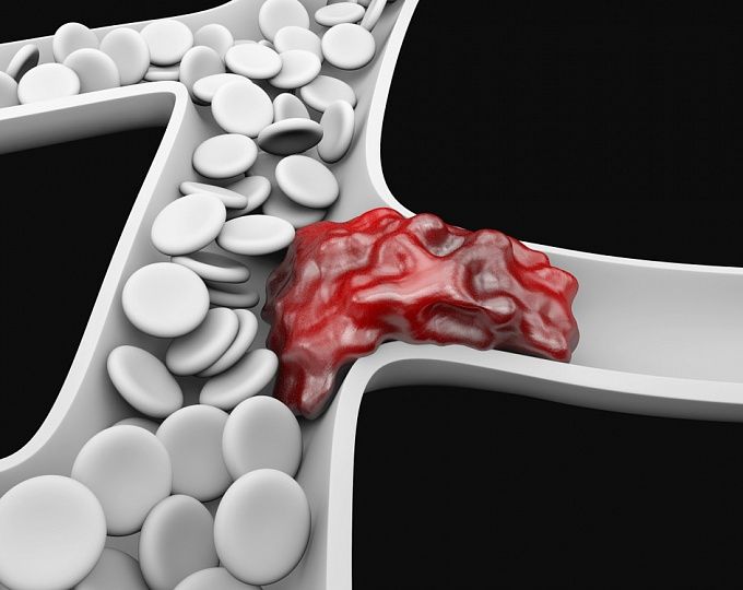 Qəfil nəfəs tıxanması  tromb əlaməti    ola bilər