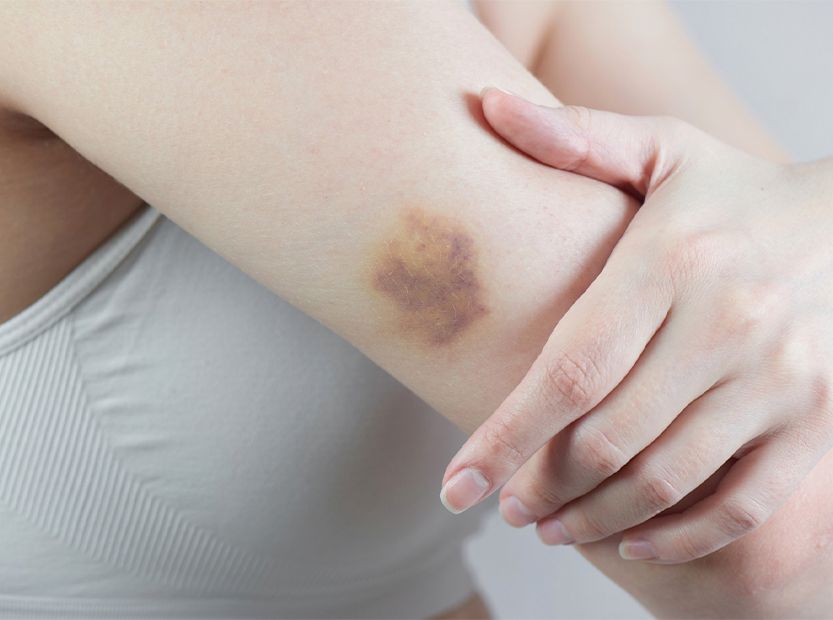 Əl-ayaqda səbəbsiz göyərmələr  – Nə çatışmır?