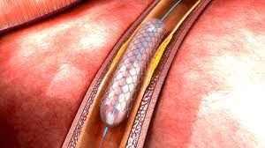 Ürəyə stent hansı hallarda qoyulur? 