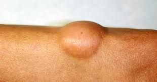 Lipoma –jirovik nədir və niyə yaranır? 