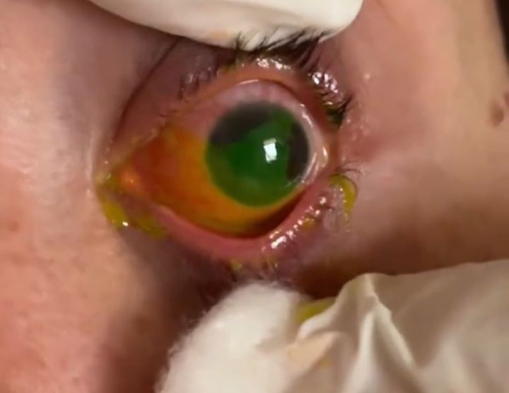 Gözünə potaş məhlulu töküldü, yandı -  VİDEO