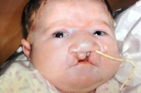 13 mart – Dünya Patau Sindromu günü  – Nadir genetik xəstəlik