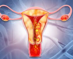 Yaşlı qadınlarda uşaqlıq qanaması -  Endometrium Qalınlaşması (Hiperplaziya)