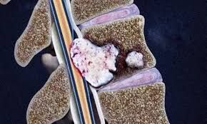 Xərçəngin metastaz verdiyini göstərən    - 5 Əlamət