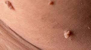 Cinsi orqandakı ziyillər xərçəngə çevrilir? 