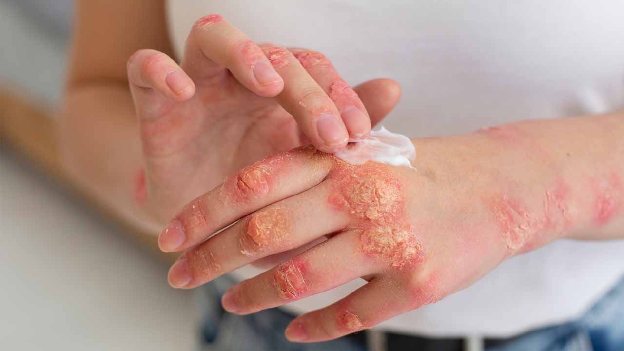 Ekzemaya qarşı krem resepti -  Dərini nəmləndirir