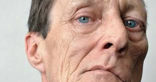 Mikro-insultun 5 təcili əlaməti - Hər kəs yoxlansın