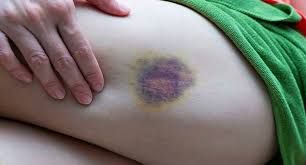 Bədəndə göyərmə, qançırlar sağalmır?   – Bu orqanı yoxlat